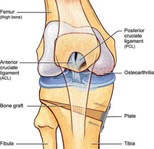 osteoarthritis